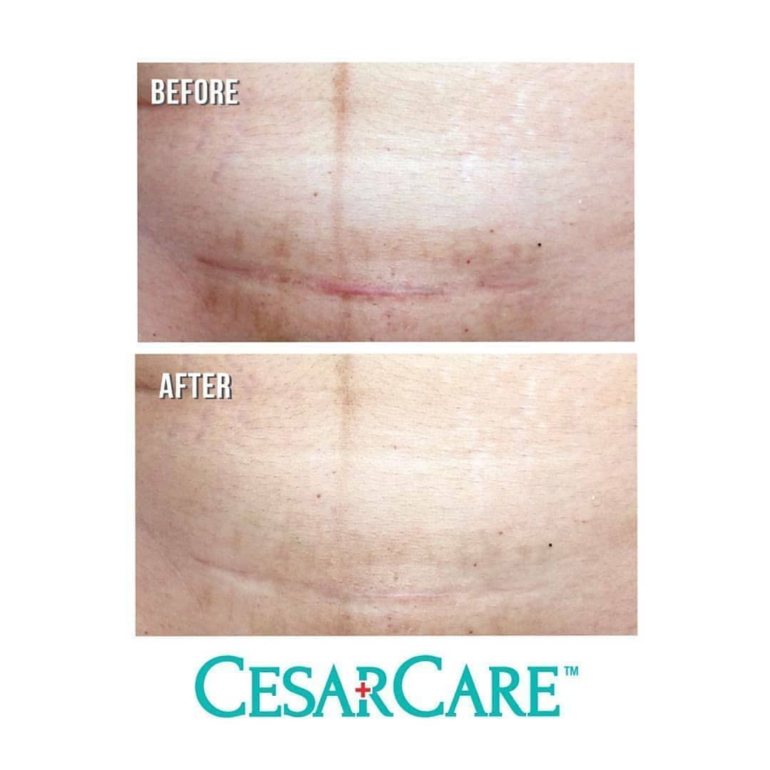 Ministry of mama รุ่น CesarCare กางเกงชั้นในดูแลแผลหลังผ่าคลอด