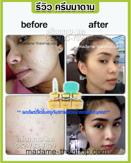 เซทสิวยุบ ผิวมัน ผดผื่น เซท 5 กรัม มาดาม ออแกนิค